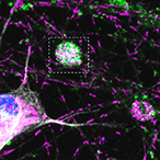 Purple mitochondria and green autophagosomes appear as lines and blotches against a black background. A large purple, green, and white ball representing swelling in the axon appears in the center and is outlined by a white dashed line. The neuron cell body is visible in the lower left.