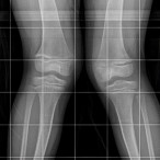 X ray image of bones from the thigh, knee, and feet are white and gray against a black background. The knees are bent inward.