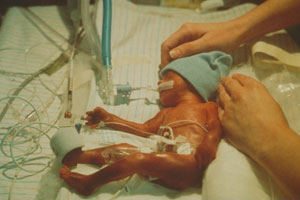 Premature baby in neonatal intensive care