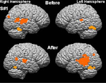 fMRI of right and left hemispheres of brain
