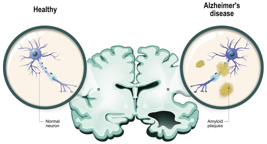 Illustration of the difference between healthy neurons and brain (left) and the brain and neurons in Alzheimer’s disease (right). The right side contains amyloid plaques.
