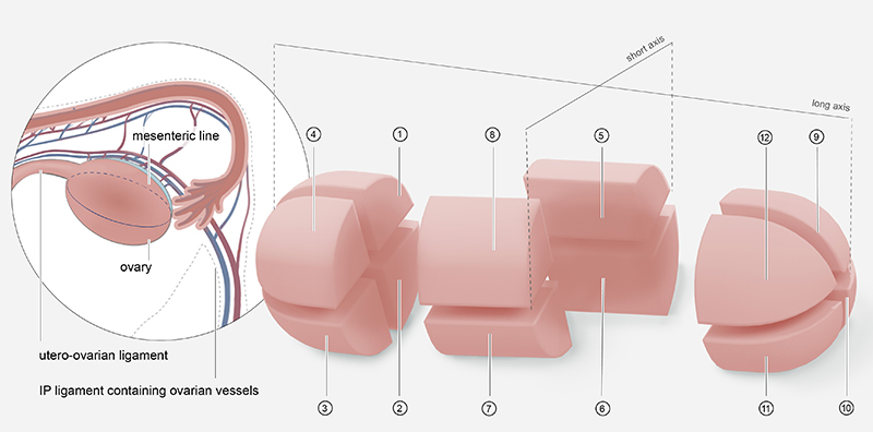 Illustration showing the ovary, utero-ovarian ligament, mesenteric line, and infundibulopelvic (IP) ligament containing ovarian vessels. On the right, a depiction of an ovary divided into 12 anatomical zones along its short and long axes.