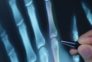 x-ray image of bones in hand
