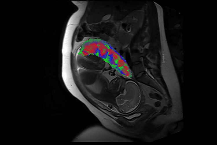 A cross-section of a human abdomen with fetus is shown in black and white, whereas the placenta is at the top of the uterus and shown in color.