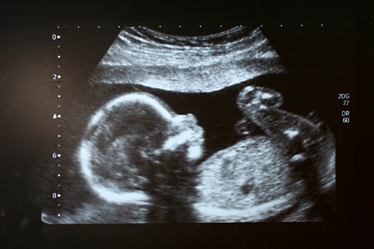 A black and white sonogram of a fetus.