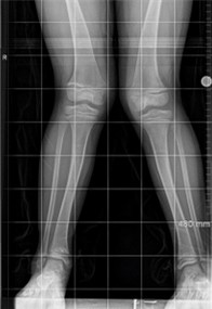 X ray image of bones from the thigh, knee, and feet are white and gray against a black background. The knees are bent inward.