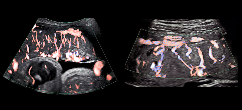 Two ultrasound images of the placenta with red and blue coloring to indicate blood flow appear side by side against a black background.