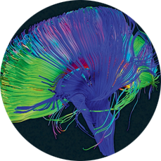 Diffusion tensor image of brain