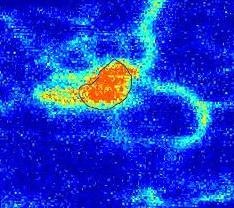 Velocimetrie Laser Doppler Image of Karposi's sarcoma.