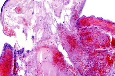 Microscopic slide of ruptured follicular cyst.