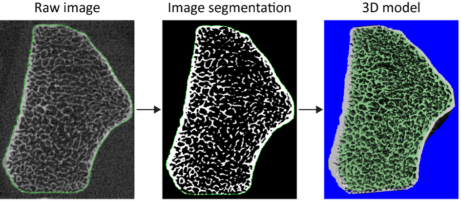 3D image processing of distal radius by HRpQCT, progressing from the original/raw scan through segmentation to the final 3D reconstruction.