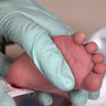 Newborn screening heel stick.