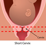 Normal length and short cervix.