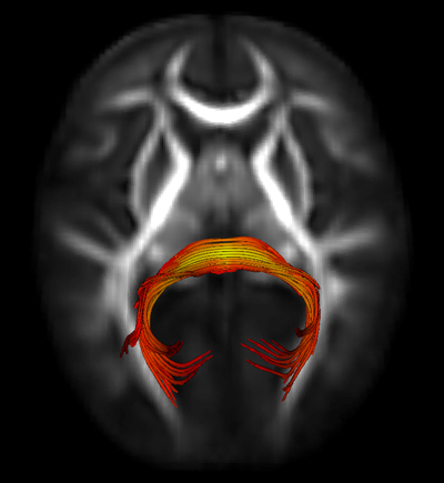 When they were infants, children who were later diagnosed with autism took longer to shift their gaze during a measure of eye movements than did infants who were not diagnosed with autism. The researchers believe that brain circuits involved with a brain structure known as the splenium of the corpus callosum (shown in this scan) may account for the differences in gaze shifting between the two groups. 