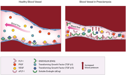 Comparison of Healthy Blood Vessel and Blood Vessel in Preeclampsia