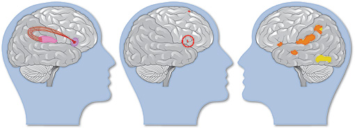 Scans of brain structure and activity involved in compensating for dyslexia, along with brain activity in a typically developing reader.