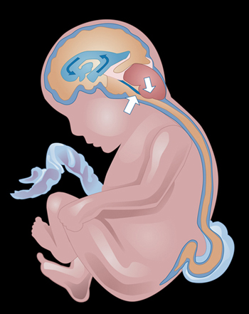 a diagram illustrating myelomeningocele and hind brain herniation