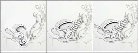 A demonstration of the bladder sling surgery undertaken in combination with pelvic floor surgery.