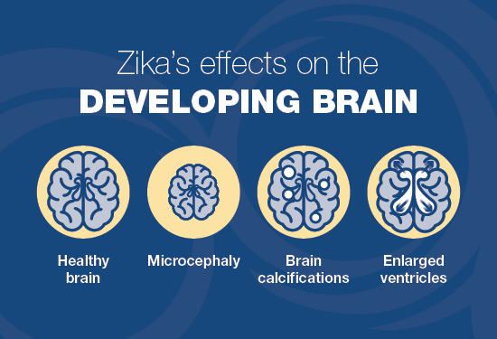 Zika's effects on the developing brain