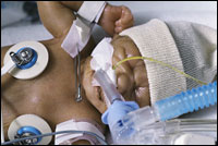 A preterm baby on a breathing tube